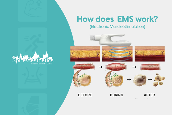EMS treatment for post pregnancy weight loss treatment Sleaford