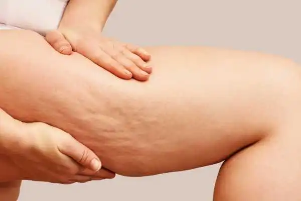 Image of woman showing leg with cellulite Sleaford