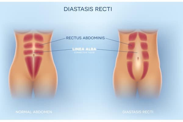 What Non-Surgical Options Are Available for Diastasis Recti Sleaford?