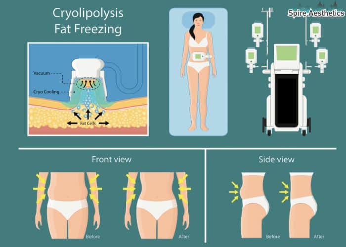 Image of diet and fat freezing combined for best results for Spire Aesthetics Sleaford