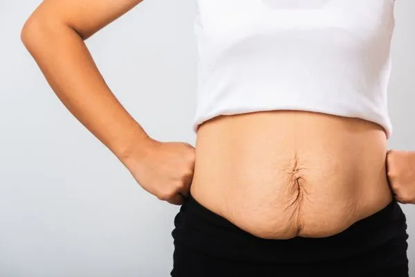 Image of a woman's stomach after weight loss with sagging skin following a gastric band Sleaford