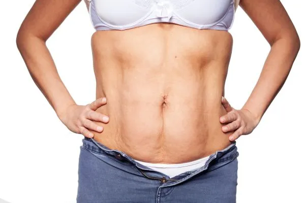 sagging skin on woman's stomach after weight loss injections Sleaford