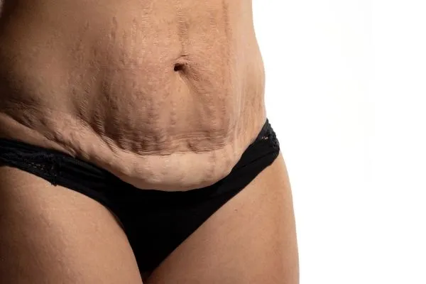 Image of womans stomach after weight loss injections Sleaford showing saggy skin