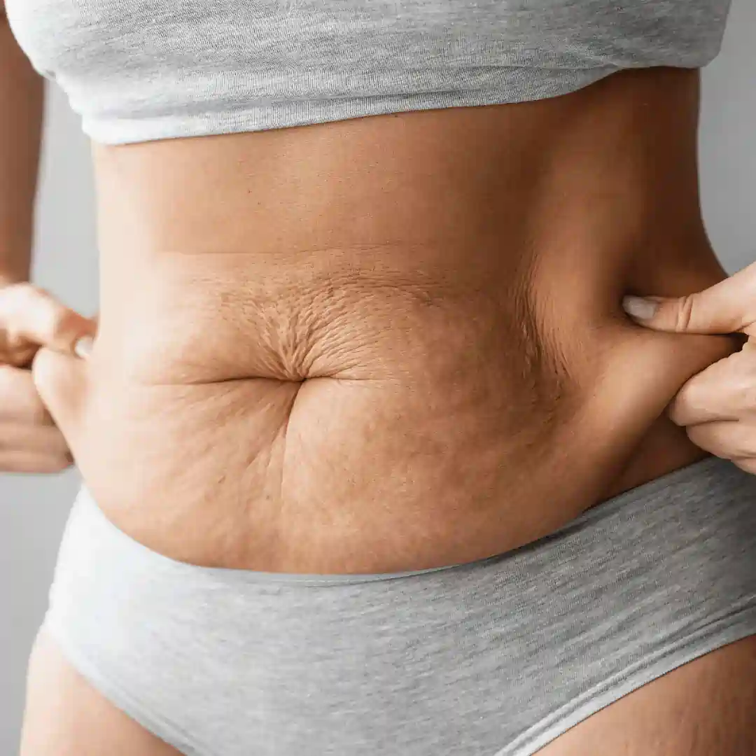 Is It Normal to Have Loose Skin After Pregnancy Sleaford?